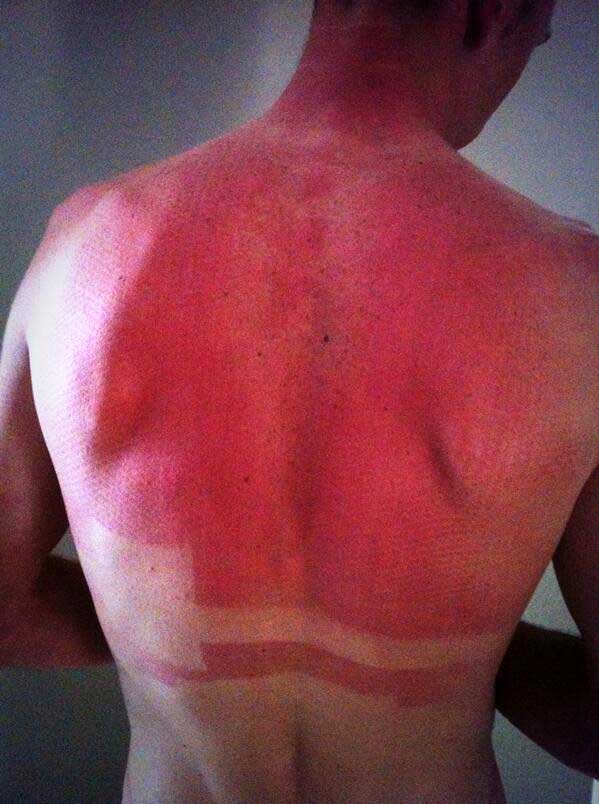 Photo: Chris Froome suffers from badly sunburnt back after wearing Team Sky's new mesh fabric skinsuit. 